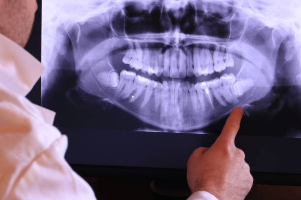 Best Emergency Wisdom Tooth Extraction in Yoakum, TX